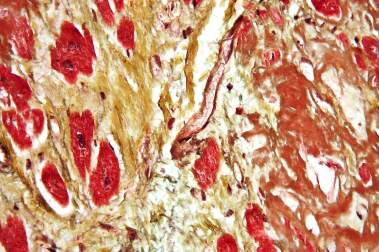 Micrografía de un corazón con fibrosis (amarillo) y amiloidosis (marrón). Tinción de Movat.