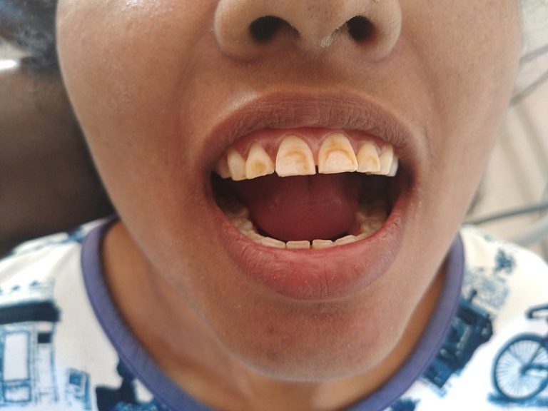 800px-Dental_Flurosis_(teeth_with_brown_stains)