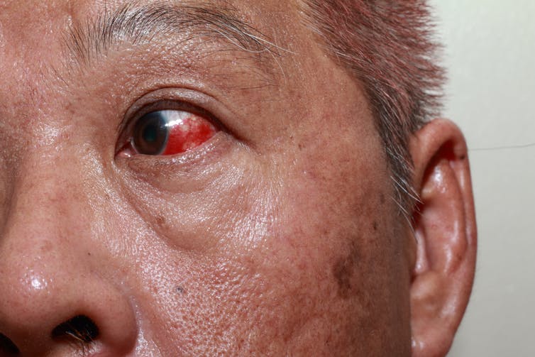 Hombre con una mancha de sangre en el ojo