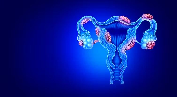 Endometriosis: su posible relación con el sistema inmunitario